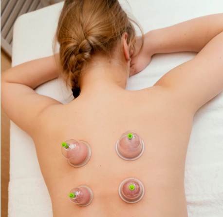 cupping therapy