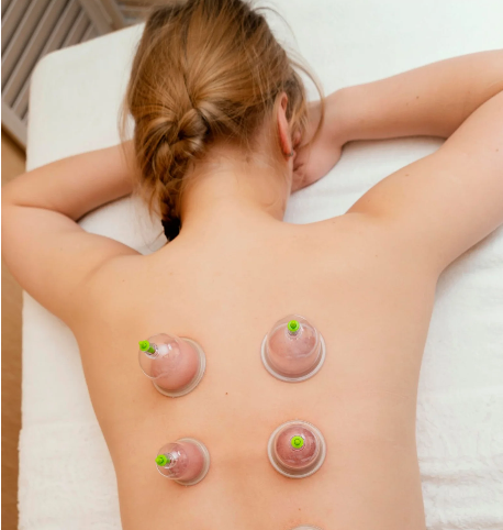 Why Choose Cupping Therapy at RRR Wellness Edmonton?