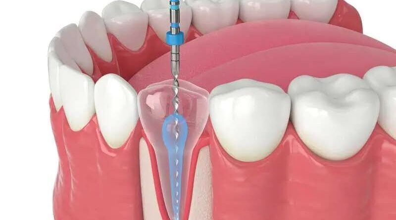 When Do You Really Need a Root Canal Treatment? Common Symptoms, Causes and Treatment Options