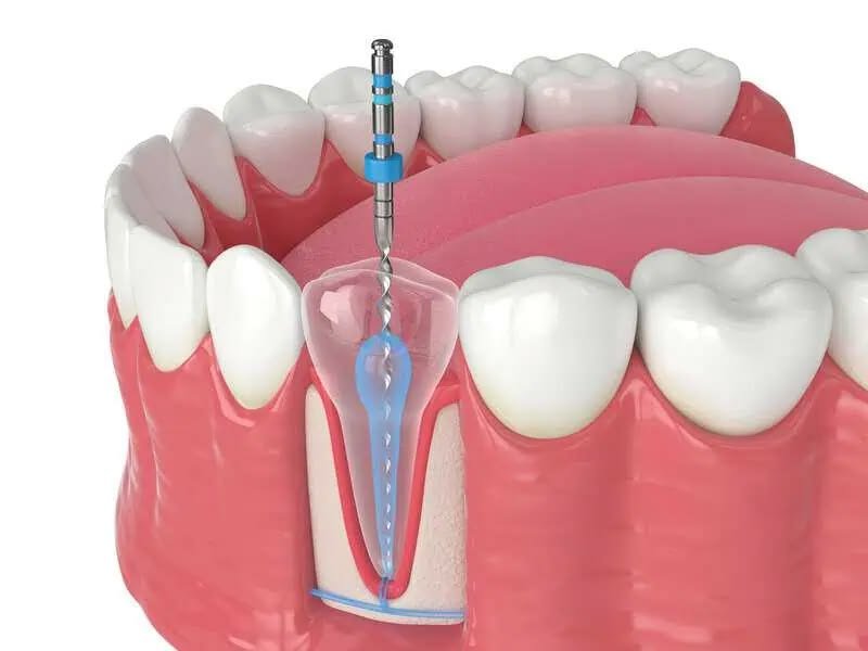 When Do You Really Need a Root Canal Treatment? Common Symptoms, Causes and Treatment Options