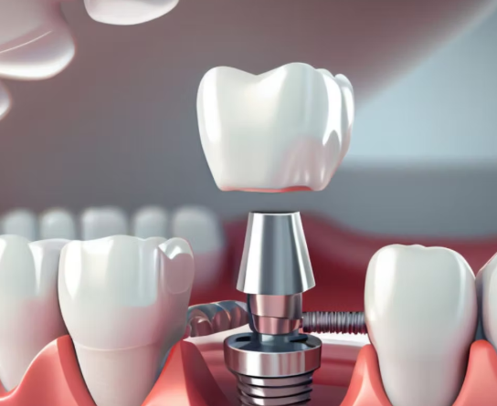 Understanding the Cost of Dental Implants in Nashik