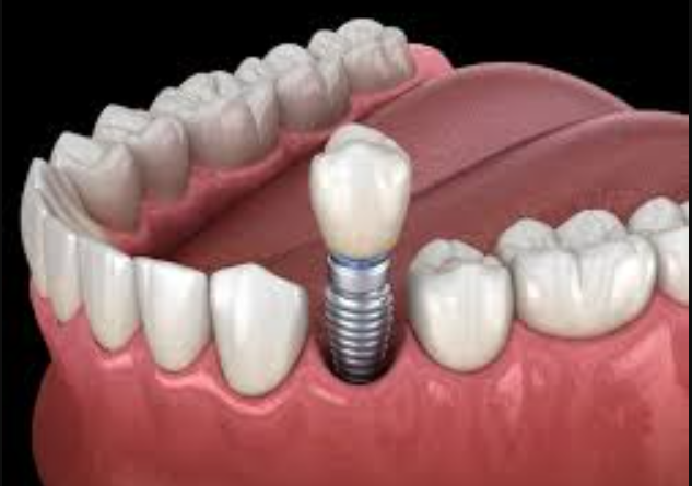 Best Dental Implants in Nashik