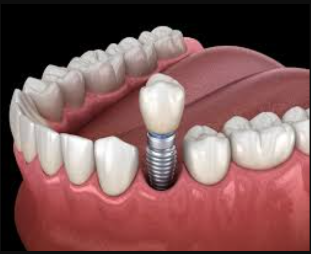 Best Dental Implants in Nashik: Restore Your Smile, Comfort and Confidence