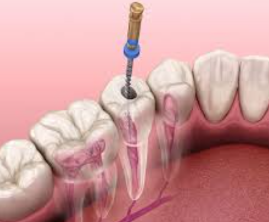 Does RCT Hurt?