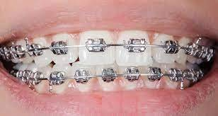 Braces or Clear Aligners: What Should You Choose?