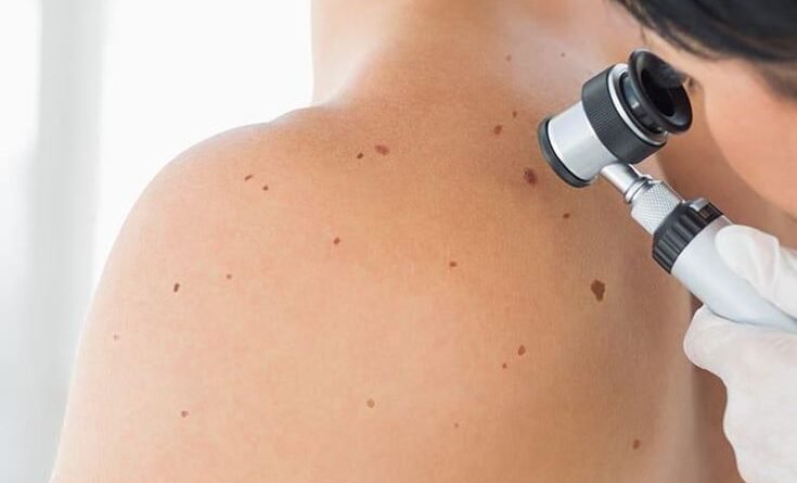 Skin Screening: The Importance of Early Detection