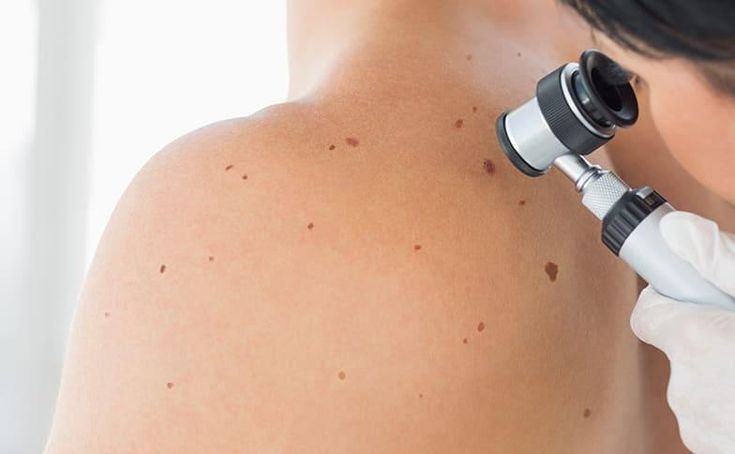 Skin Screening: The Importance of Early Detection