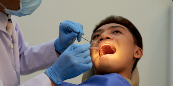 Best Ways to Replace Missing Teeth in Nashik: Implants, Bridges and Dentures
